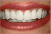 Smile after Teeth whitening treatment