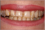 Smiling face before veneers treatment from dentist